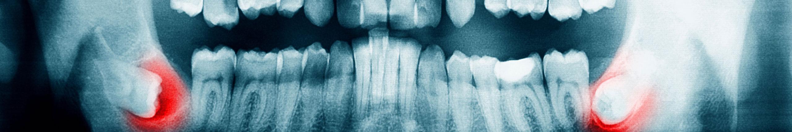 DENTS DE SAGESSES
