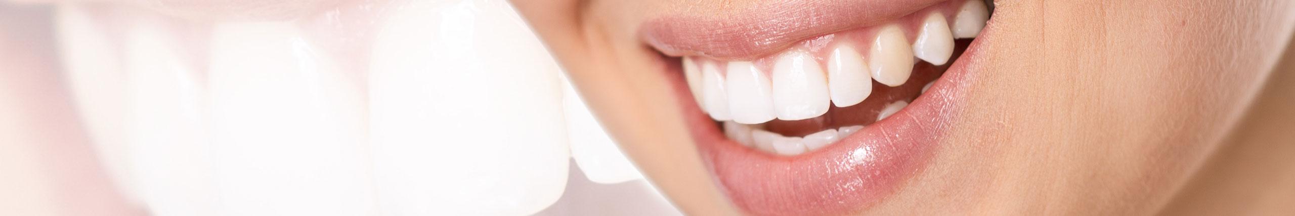 Blanchiment des dents