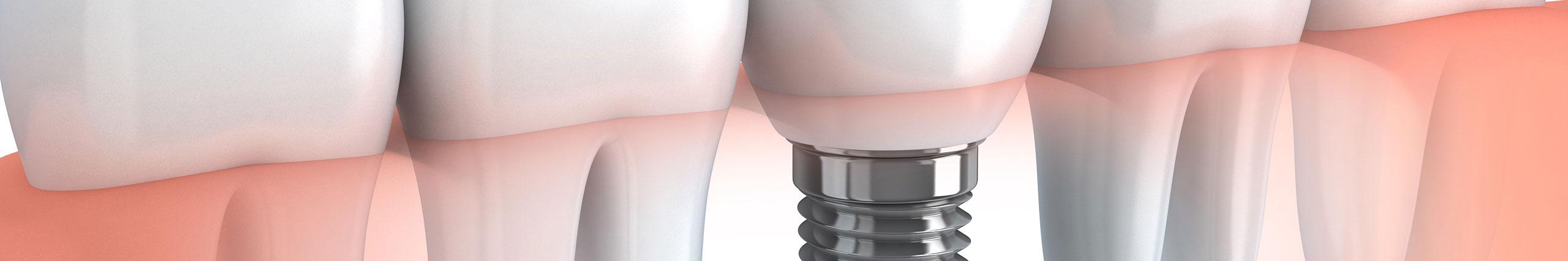 Implants dentaires